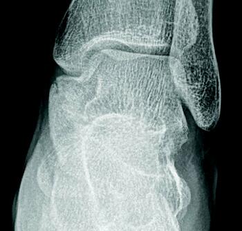 This anteroposterior radiographic view shows the same coalition as illustrated in the image above. Imaging is confirmatory and aids in planning intervention.