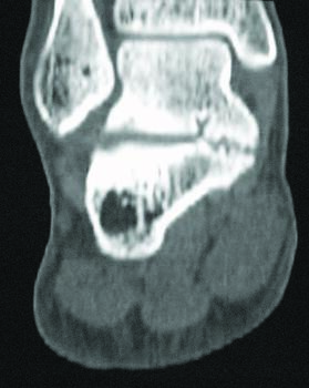This preoperative computed tomography (CT) image shows an incomplete middle facet talocalcaneal coalition.