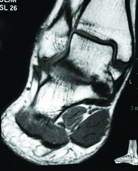 This magnetic resonance imaging (MRI) shows the same incomplete middle facet talocalcaneal coalition as on the left.