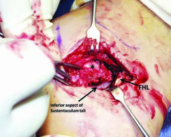 This intraoperative photo illustrates exposure of the talocalcaneal coalition prior to resection.