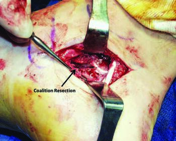 In this intraoperative photo, one can see the now resected incomplete talocalcaneal coalition.