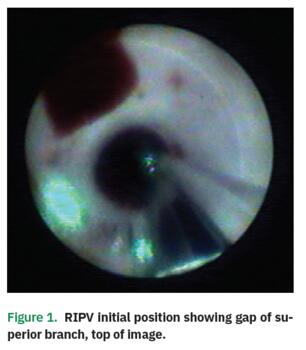 Figure 1. RIPV initial position showing gap of superior branch, top of image.
