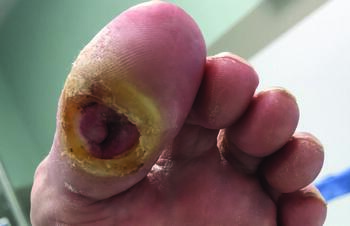 This photo shows a plantar hallux ulcer that probed to bone with bone marrow edema on magnetic resonance imaging (MRI), suggesting osteomyelitis.