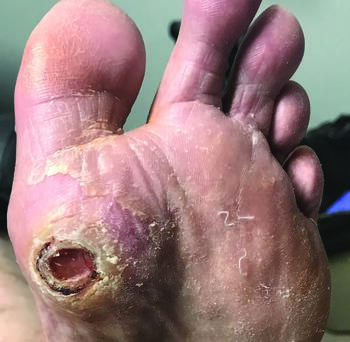 While the author shares there is a lack of literature on the topic, he says he finds Keller arthroplasty to be an option for plantar first metatarsal head ulcers, as seen here.