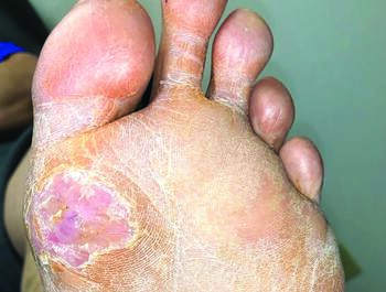 This photo shows the same ulcerative area as in the photo above, but after performance of a Keller arthroplasty.