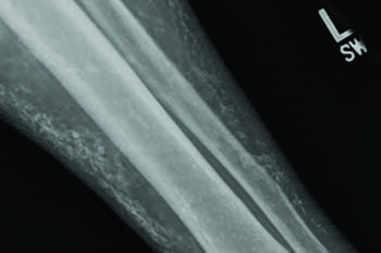 This radiographic image shows multiple soft tissue calcifications along the anterior tibia and fibula with no evidence of cortical disruption.
