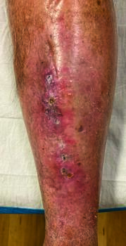 As one can see in this photo, the patient greatly improved over three months of therapy, achieving near resolution of all open areas on the left anterior leg.