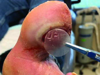 This photo shows an application of an 18 mm EpiFix  (MiMedx) disc. Kazu Suzuki, DPM, CWS says cellular tissue innovations are one development that made a difference in his practice. Photo courtesy of Golta Eragi, DPM.