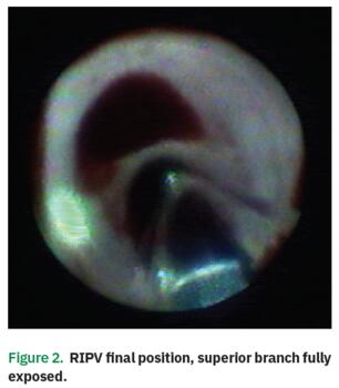 Figure 2. RIPV final position, superior branch fully exposed.