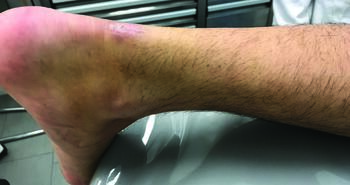 Here one can see a healed incision of an Achilles tendon repair. The author notes he will use a larger incision if he cannot reach the proximal tendon tear through a small incision.