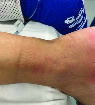 In this photo, one can appreciate the palpable gap and foot sag often present with Achilles rupture. A positive Thompson test may also be evident in these cases.