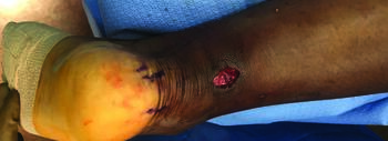 In this intraoperative photo, one can see the incision placement and angle of ankle plantarflexion position after a minimally invasive Arthrex  Percutaneous Achilles Repair System (PARS) procedure.