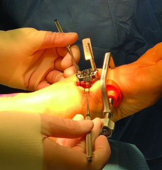 J.P. McAleer, DPM, FACFAS says the Lapiplasty  Mini-Incision™ System can remove the need for free-handed, estimated bone cuts while using a smaller incision. Photo courtesy of J.P. McAleer, DPM, FACFAS