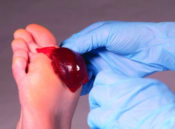 Robert Snyder, DPM, MBA, MSc, CWSP, FFPM RCPS (Glasg) shares that ActiGraft , seen above, contains growth factors, macrophages and substrates for wound closure. Photo courtesy of RedDress Medical.