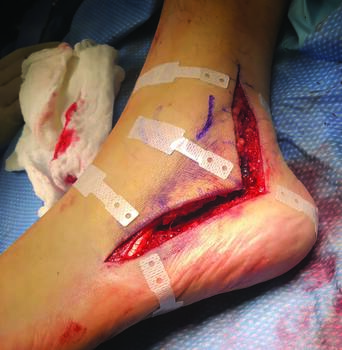 Arun Karwal, DPM initially used the HEMIGARD system, seen above, in amputation cases, but has since used it for traumas and other high-risk incisions. Photo courtesy of Arun Karwal, DPM.