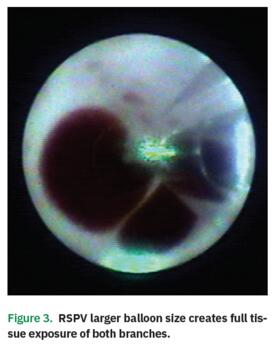 Figure 3. RSPV larger balloon size creates full tissue exposure of both branches.