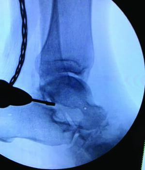 Utilizing a minimal-incision approach, this image shows a midfoot osteotomy made at the level of deformity and joints pr epared using MIS burrs. Photo courtesy of the Rubin Institute.
