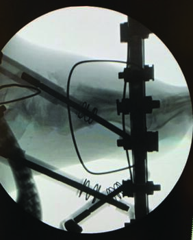 This image demonstrates intraop fluoroscopy of the MIS osteotomy site, after which the surgeon applies a 6-axis exter nal fixator. Photo courtesy of the Rubin Institute.