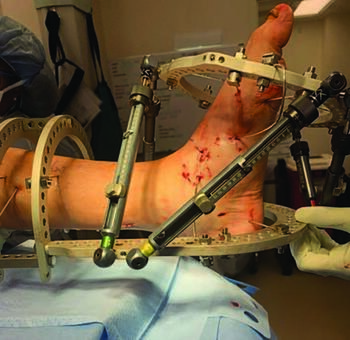 Following MIS osteotomy, a 6-axis external fixator aids in gradual correction of deformity over three weeks. During this time the patient remains non-weightbearing. In these photos, one can see the clinical appearance of the frame following application. Photo courtesy of the Rubin Institute.