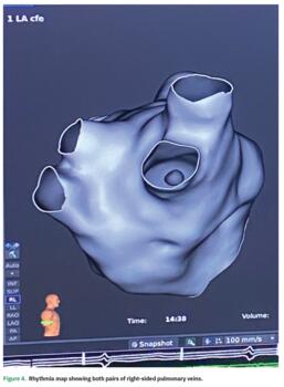 Figure 4. Rhythmia map showing both pairs of right-sided pulmonary veins.