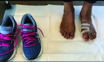 This photo shows a clinical view after minimally invasive bunion surgery. This particular patient self-transitioned to sneakers on postoperative day 10.