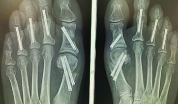 These x-ray images represent minimally invasive bunion surgery with hammertoe correction. The image on the right is four weeks postoperative and the image on the left is two weeks postoperative.