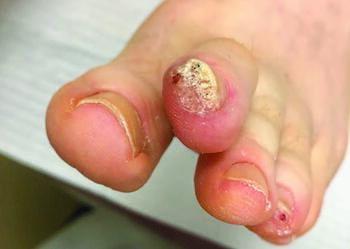 Here one can notice the distal nail with wormholes, or digitations that extend into the nail plate, and in this case ther e is also a subungual verruca.