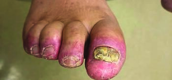 In this photo, one can see a nail for which the differential diagnosis would also include nail psoriasis, important to consider for dystr ophic nails.