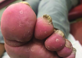 This photo illustrates the importance of looking distally at nail plate in this patient with onychomycosis.