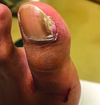 Here on can see a nail unit with discoloration, but a different benign tumor; a fibroma present on lateral nail fold edge.