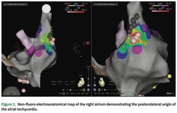 Salzberg - Therapies for Atrial Fibrillation - Figure 2