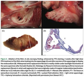 Mehta - Pulsed Field Ablation - Figure 3