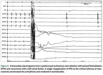 Mehta - Pulsed Field Ablation - Figure 5