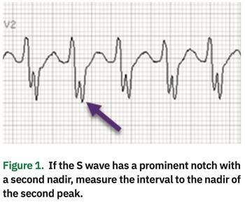 Jones - Brugada Criteria - Figure 1