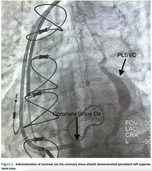 Kleyman - Coronary Sinus Ostial Stenosis - Figure 1