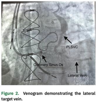Kleyman - Coronary Sinus Ostial Stenosis - Figure 2