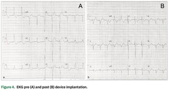 Kleyman - Coronary Sinus Ostial Stenosis - Figure 4