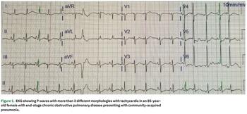 Bhattad - Multifocal Atrial Tachycardia - Figure 1