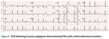 Prousi - Ventricular Tachycardia - Figure 2