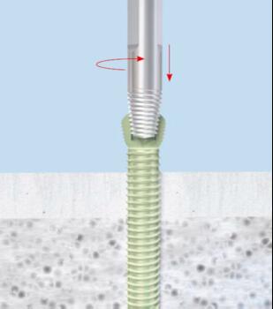 A conical extraction device will purchase a stripped screw head when engaged with the screw head recess and turned counterclockwise. Figure courtesy of DePuy Synthes.
