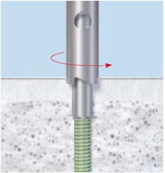 A hollow reamer may be used to attain exposure of a broken screw shaft. Figure courtesy of DePuy Synthes.