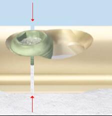 A cutting wheel is used to cut the plate around the cold-welded screw to allow for plate removal, followed by screw removal. Image courtesy of DePuy Synthes.