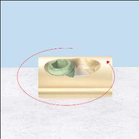 A cutting wheel is used to leave a portion of the plate with the cold-welded screw. This plate segment is used as a handle to rotate and remove the plate and screw as a unit. Image courtesy of DePuy Synthes.