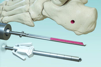 According to In2Bones, the CoLink Harvester allows surgeons to enhance bony healing of fractures and fusions by morselizing harvested cancellous bone into chips as part of a sterile, single-use kit. Photo courtesy of In2Bones.
