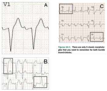 Jones - Brugada Criteria - Figure 3