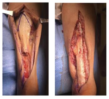 Here one can see exposed Achilles tendon after resection of nonviable tendon distally, resulting in a 6 cm defect (left).  After V-Y lengthening of the proximal gastrocnemius aponeurosis, the distal defect was less than 1 cm, which was then bridged with acellular allograft (right).