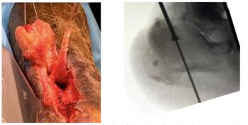 After confirmed resolution of osteomyelitis with resection of infected bone, use of antibiotics beads, six-weeks of intravenous antibiotics, and negative bone biopsy, revisional repair took place with flexor hallucis longus tendon (FHL) transfer through the calcaneus. Harvesting of the FHL tendon was performed posterior to the ankle joint (left). A bone tunnel created through the calcaneus anchored the tendon with an interference screw after proper tensioning (right).