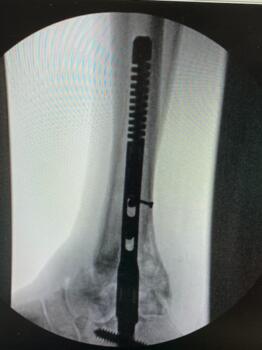 Byron L. Hutchinson, DPM, FACFAS who has used this nail since its launch several months ago, feels the stress-sharing feature within the tibia allows him to have less concern about possible tibial fracture, especially with longer nails. Photo courtesy of Paragon 28.