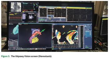 Weise - Ventricular Tachycardia Ablation - Robotic Navigation - Figure 3