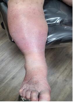 Twelve-week follow up